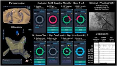 Catheter Ablation in Complex Atrial Arrhythmias: Pilot Study Evaluating a 3D Wide-Band Dielectric Imaging System